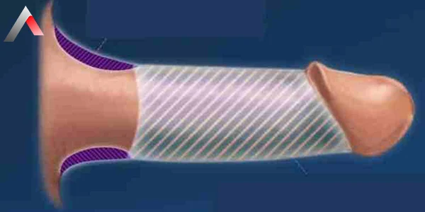 Penis kalınlaştırma kalıcı mıdır?